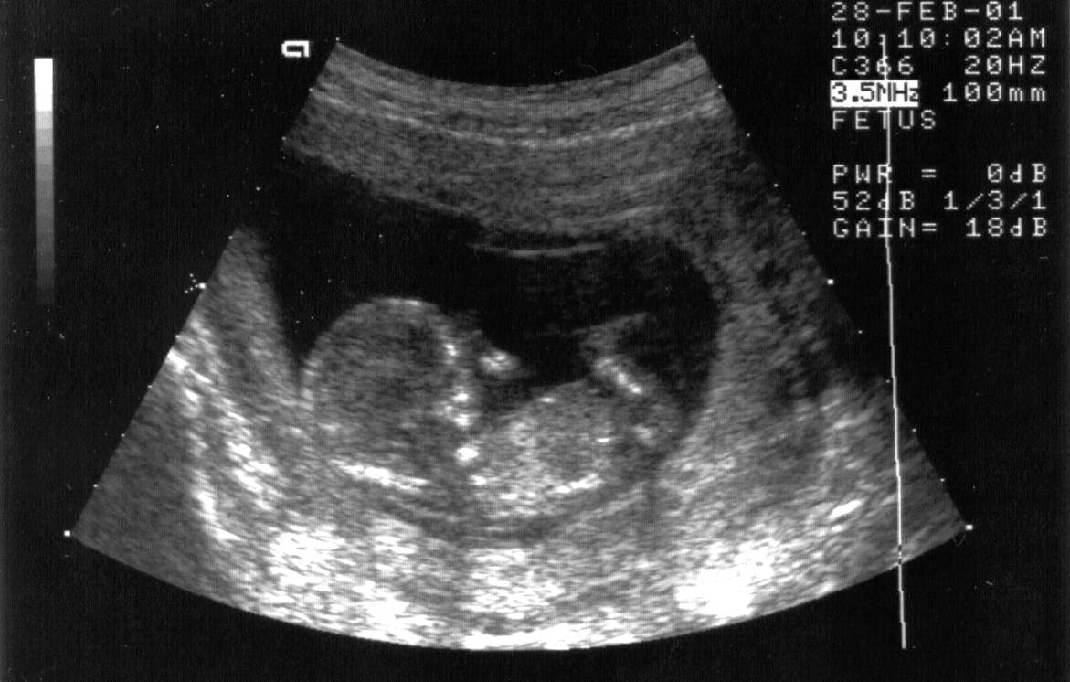 Baby 2 at 12 weeks