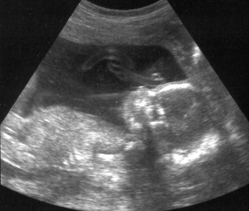 Baby 2 at 20 weeks