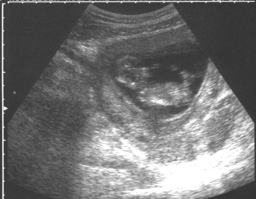 Our baby at 12 weeks